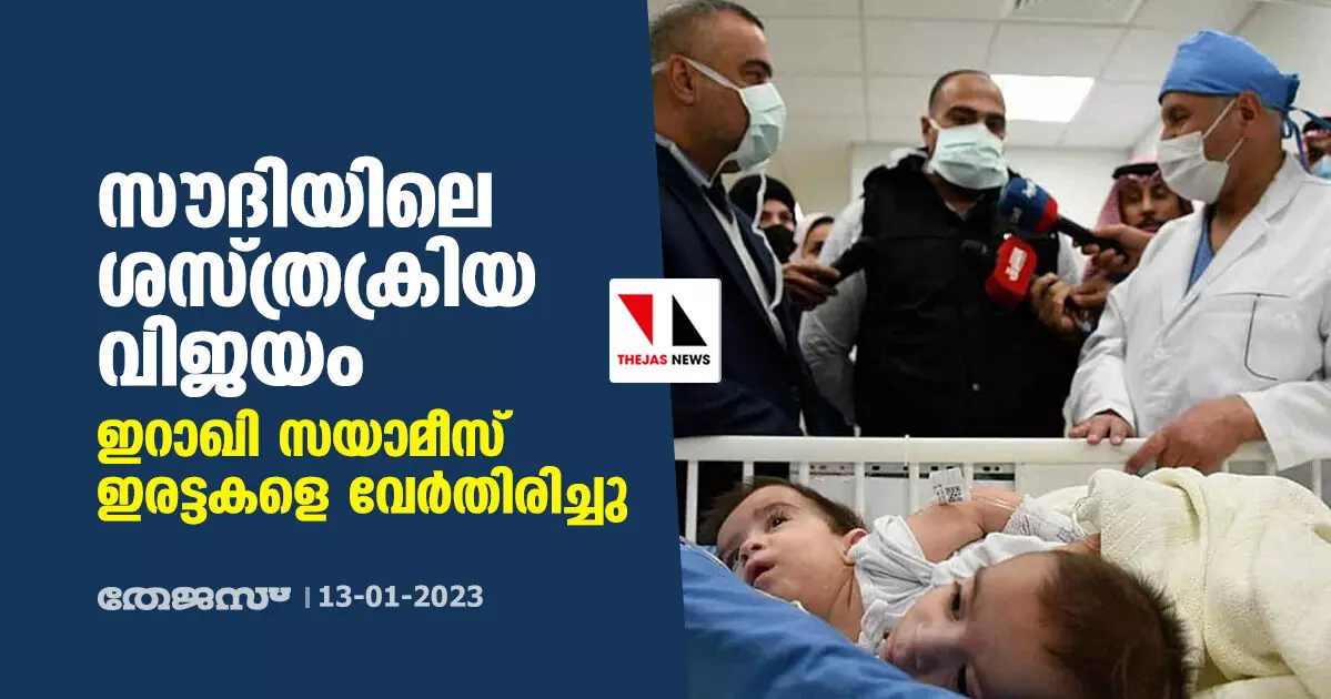 സൗദിയിലെ ശസ്ത്രക്രിയ വിജയം; ഇറാഖി സയാമീസ് ഇരട്ടകളെ വേര്‍തിരിച്ചു