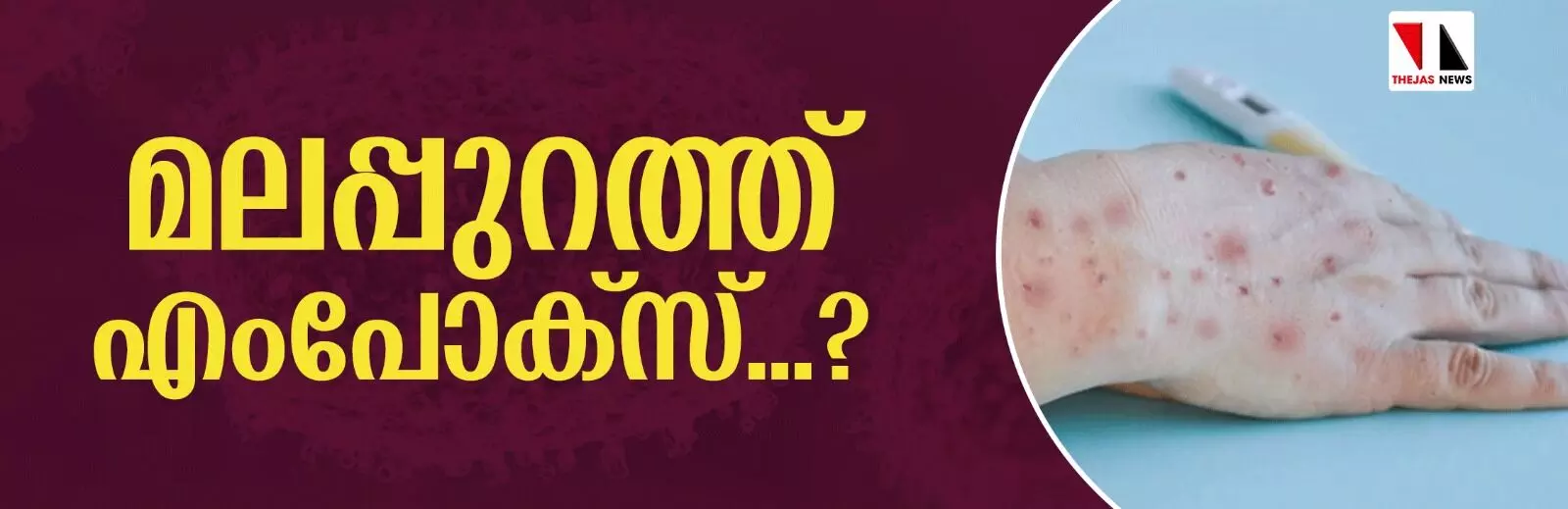 മലപ്പുറത്ത് എംപോക്‌സ് രോഗ ലക്ഷണങ്ങളോടെ ഒരാള്‍ ആശുപത്രിയില്‍